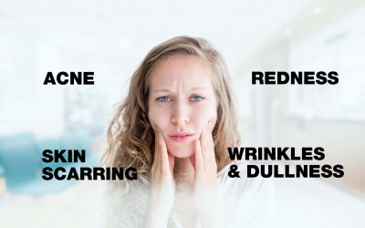 Acne, Wrinkles & Dullness, Skin Scarring, Redness: Dermapen 4 Microneedling is the Solution