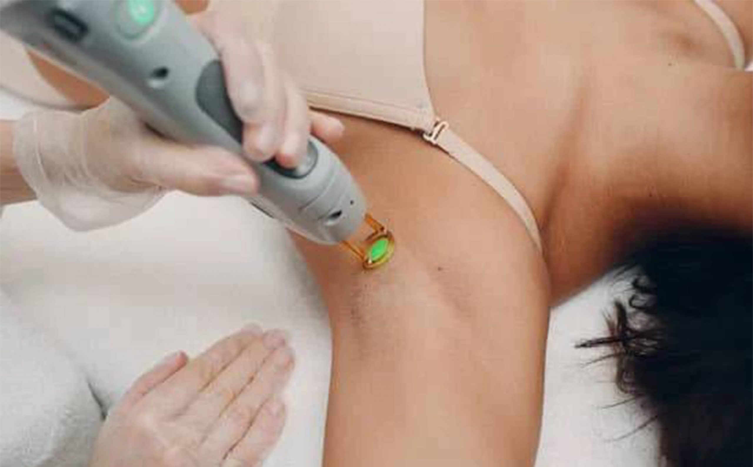 A doctor performing laser hair removal with equipment on the patient's armpit.