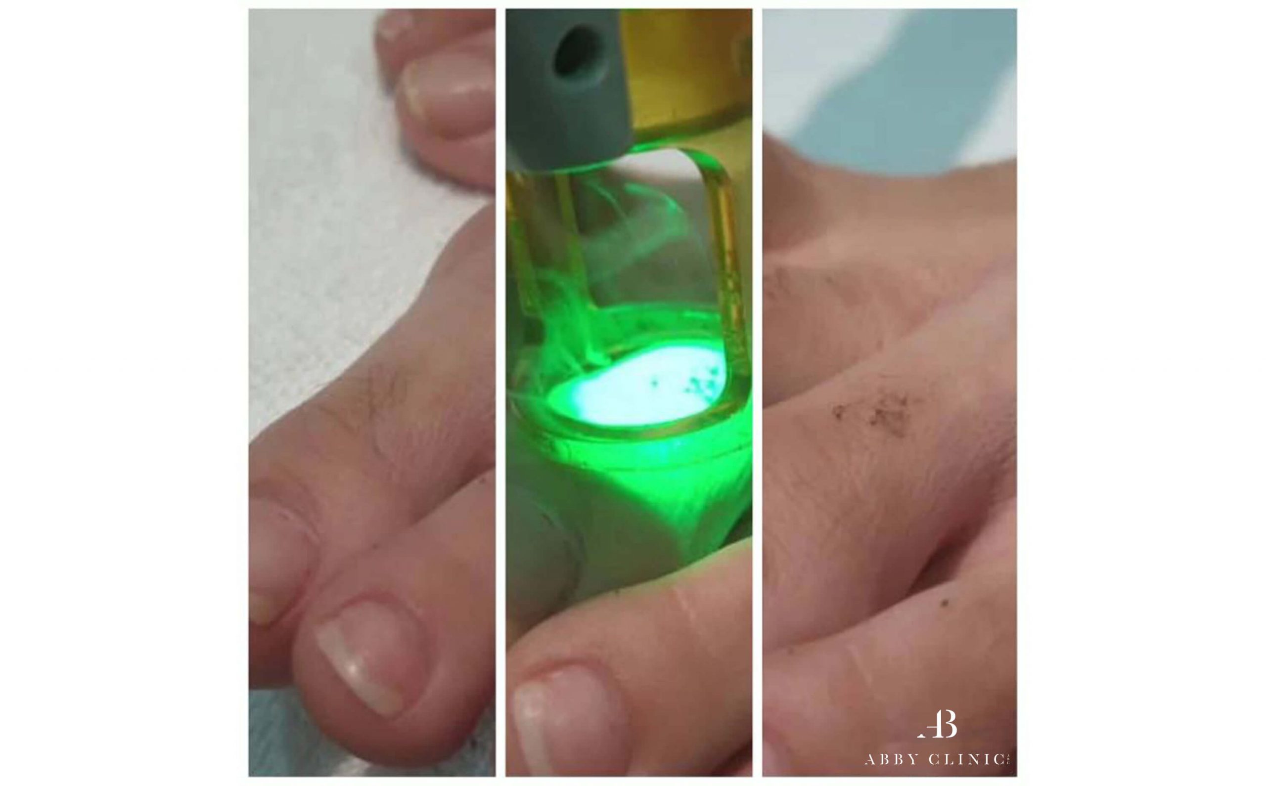 A comparison of before and after laser hair treatment on patient's toes.