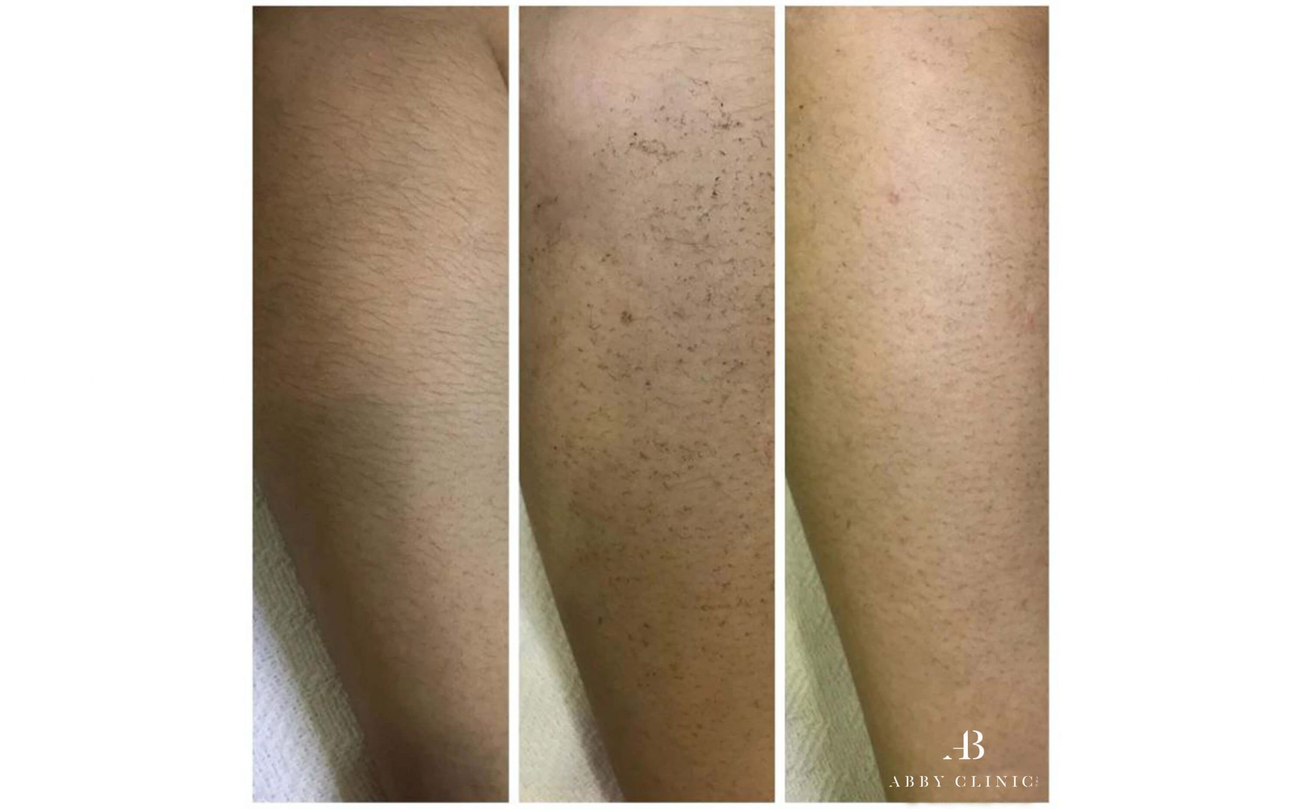 A comparison of before and after laser hair removal treatment at Abby Clinic.