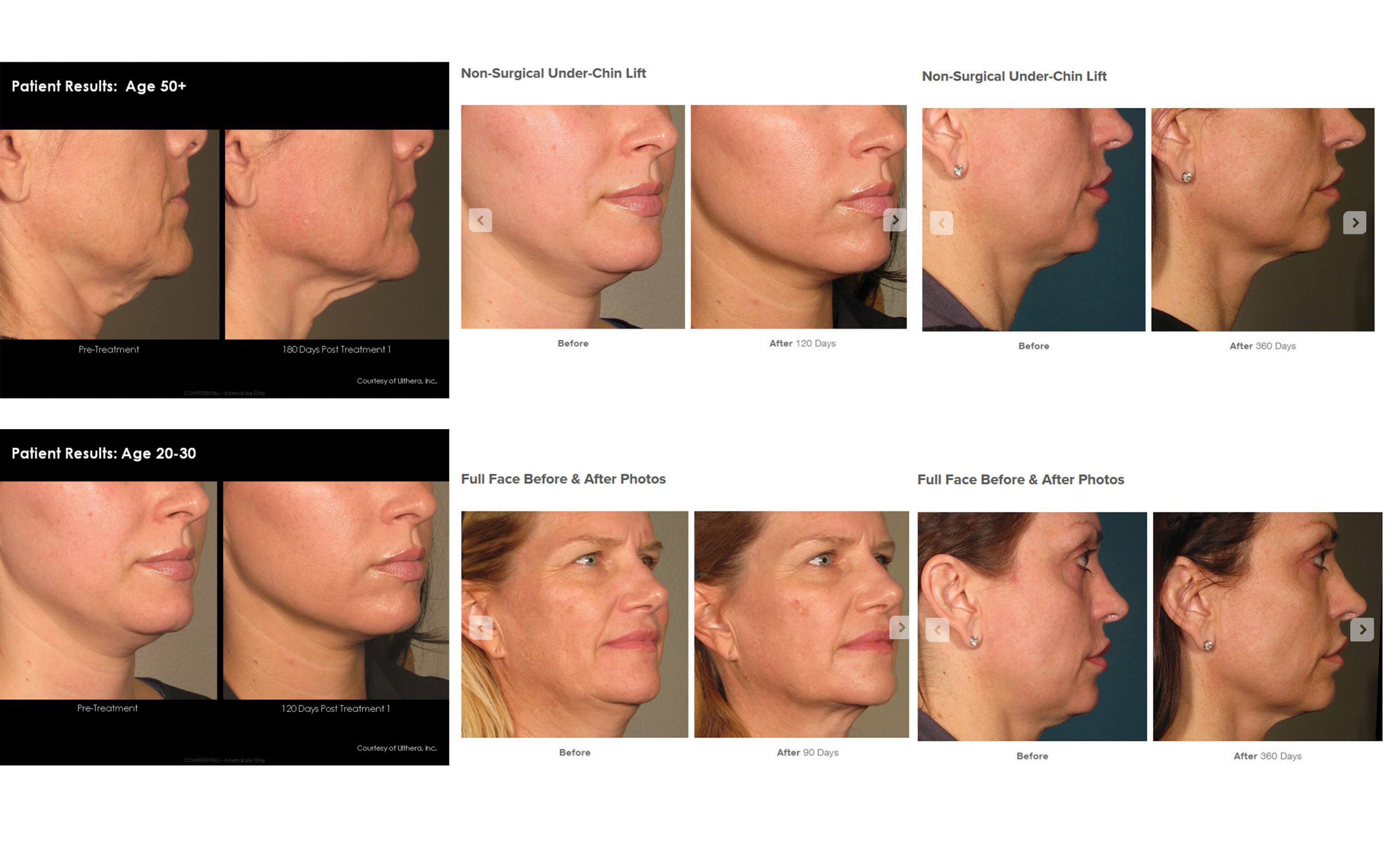 A comparison of before and after of patients that undergo Ultherapy treatment. 