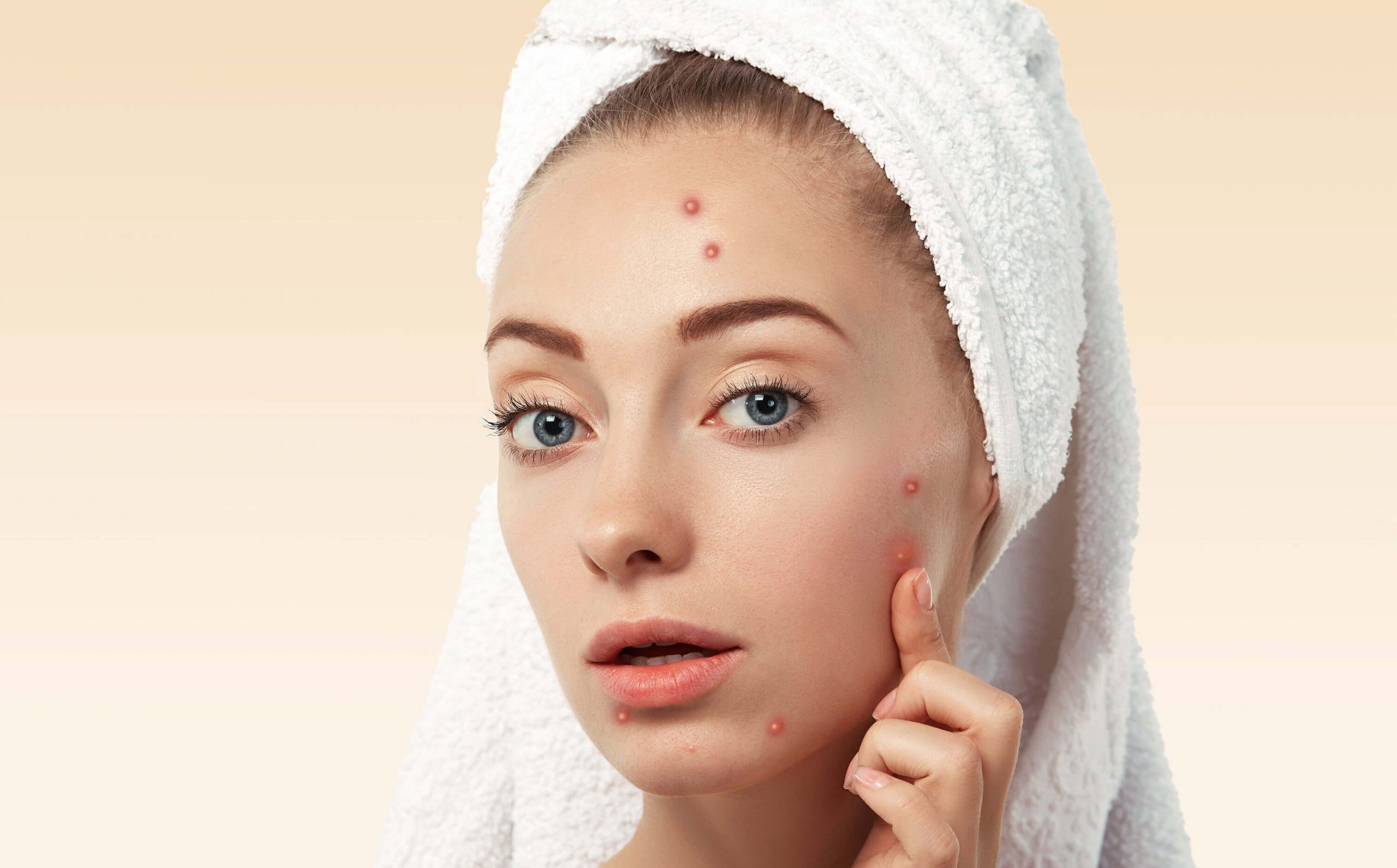 Ance Problem Image Acne Treatment