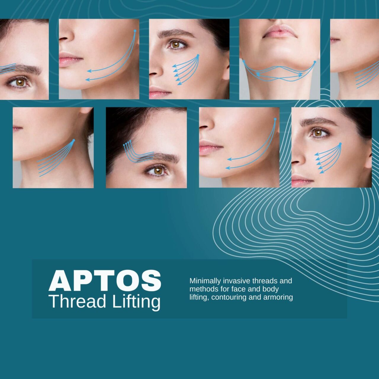 Aptos Thread Lift - Dr Abby Clinic