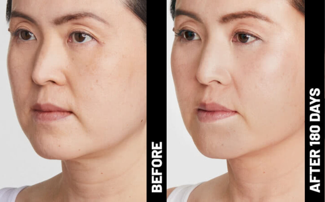 A comparison of before and after results of using Ultherapy MFU from Dr Abby Clinic
