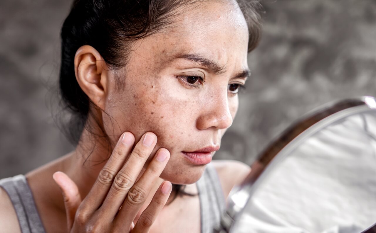 A woman inspecting a pigmentation spot on her face.