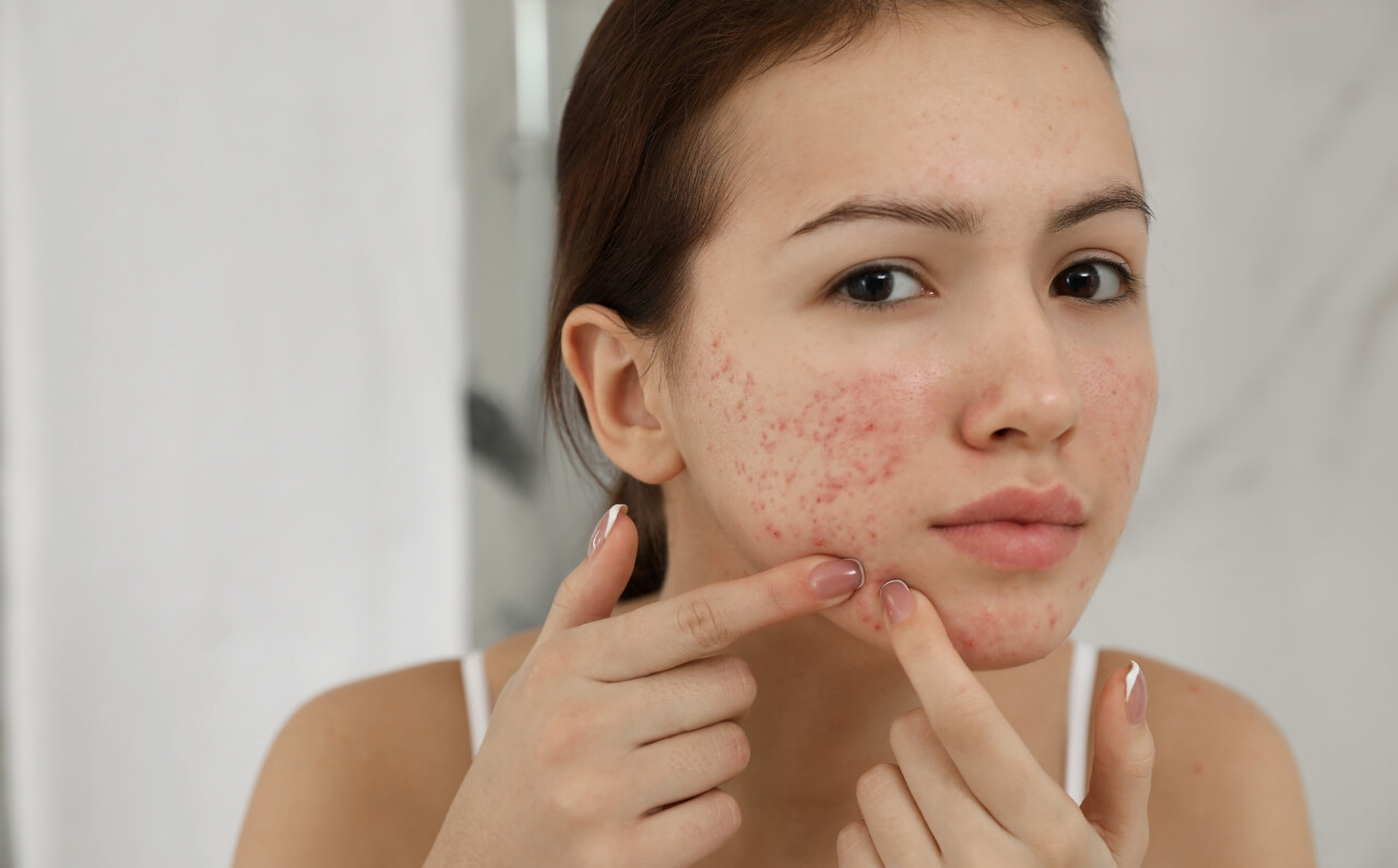 A woman with acne scars.