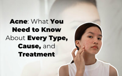 Acne: What You Need to Know About Every Type, Cause, and Treatment