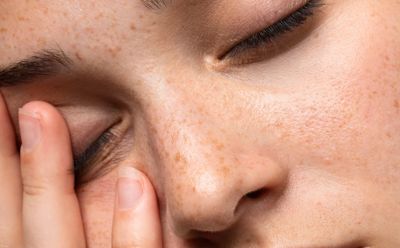 A woman with freckles, touching her face