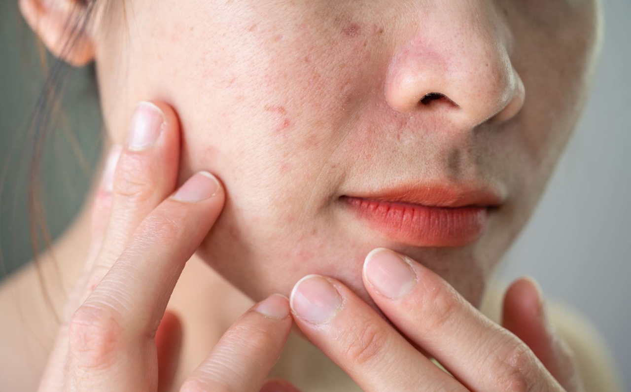 A woman touching her face, which appears dull with uneven skin texture, visible acne, and discoloration.