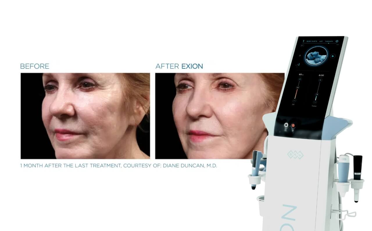 BTL Exion device with sleek design shown alongside a side-by-side comparison of stunning before and after results on the face, highlighting smoother, firmer skin.