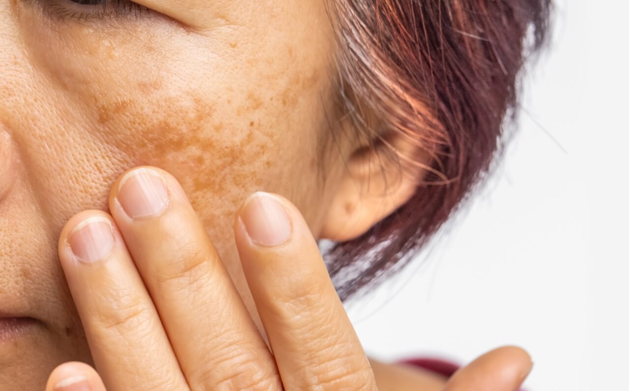 A close-up image of a woman touching her face, highlighting pigmentation issues on her skin.